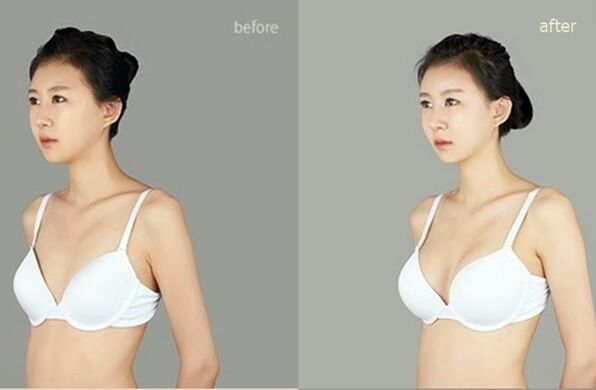 bago at pagkatapos ng plastic breast augmentation