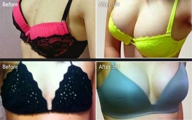 resulta ng plastic breast augmentation