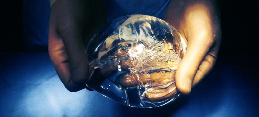 Silicone endoprosthesis